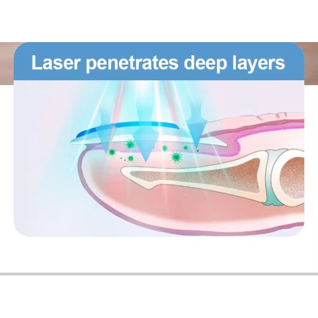 Nail Fungus TreatmentLamp