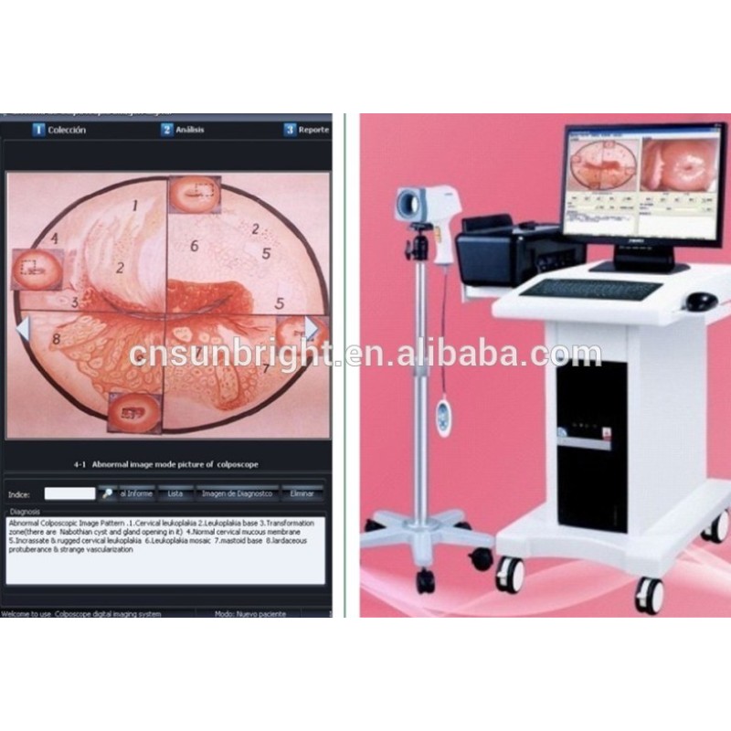Cámara HD SONY colposcopio de video digital Cámara Sony CCD Colposcopio de video digital electrónico