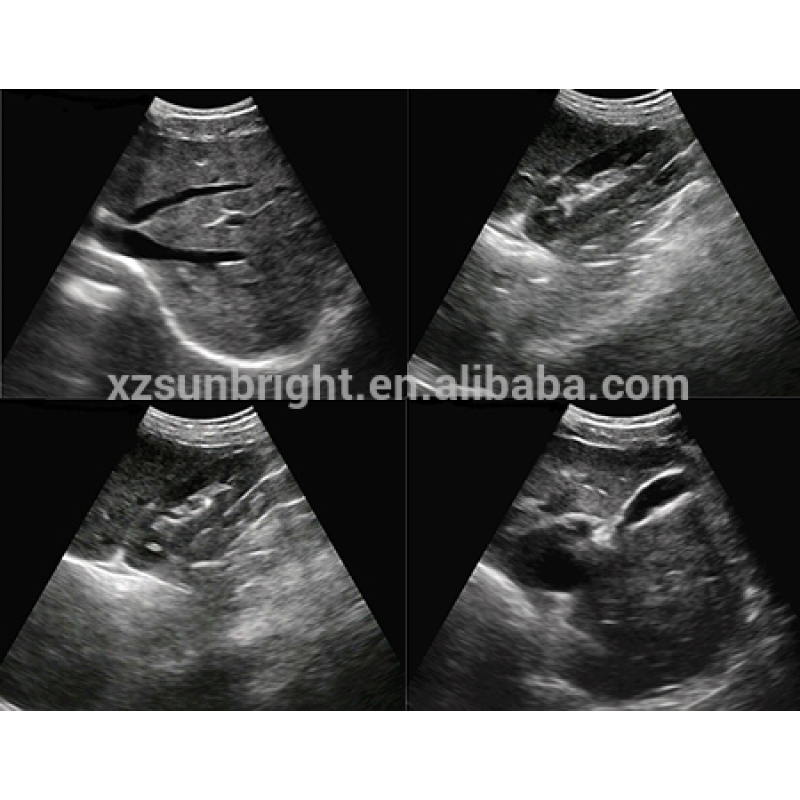 Medical homecare laptop ultrasound USB probe for mobilephone/Pad