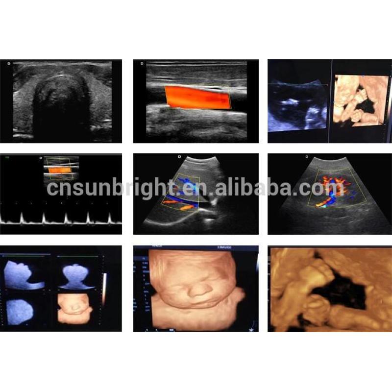 Portable 15 inch 3d 4d doppler ultrasound OB GYN color doppler imaging system