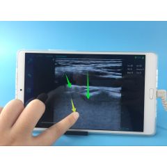 Wireless medical ultrasound instruments for iphone USB android linear probe smart phone tablet