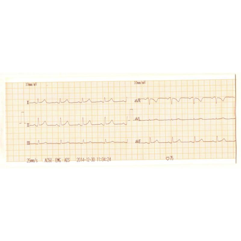 Appareil ECG portable à 3 canaux le plus vendu