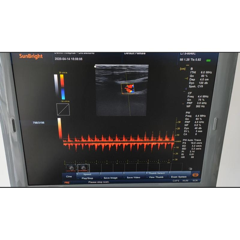 Portable Medical Ultrasound Echographe Machine 3D Color Doppler Best Ultrasound Machine