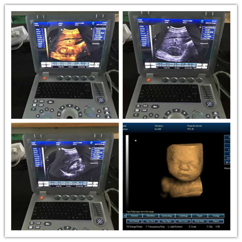 Portable laptop style Medical ecografo 3D 4D ultrasound scanning machine for hospitals