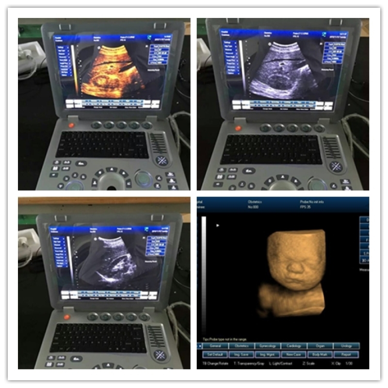 Portable laptop style Medical ecografo 3D ultrasound scanning machine 3D ultrasound scanner