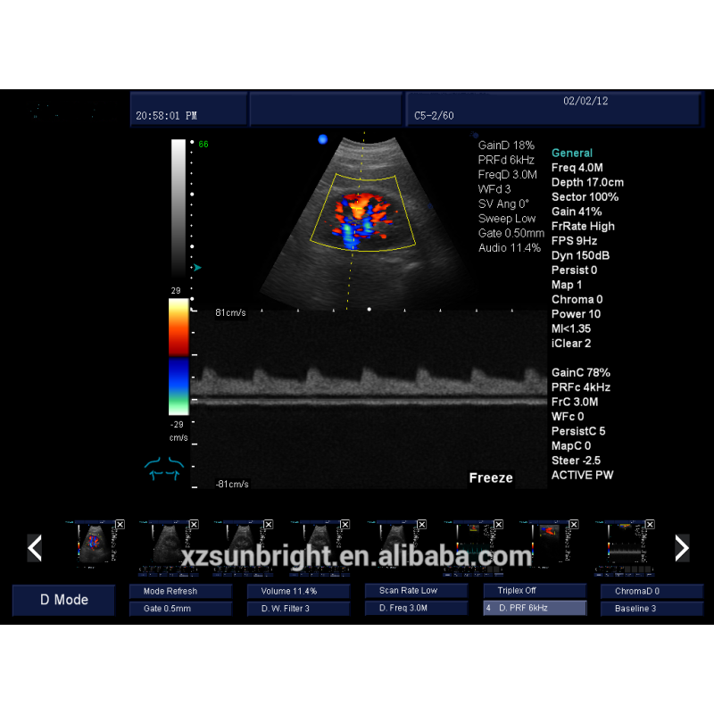 Medical hospital portable color doppler ultrasonography echographie portable