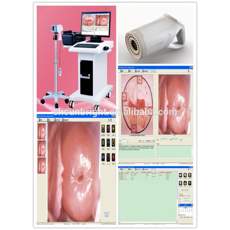 Cámara HD SONY colposcopio de video digital Cámara Sony CCD Colposcopio de video digital electrónico