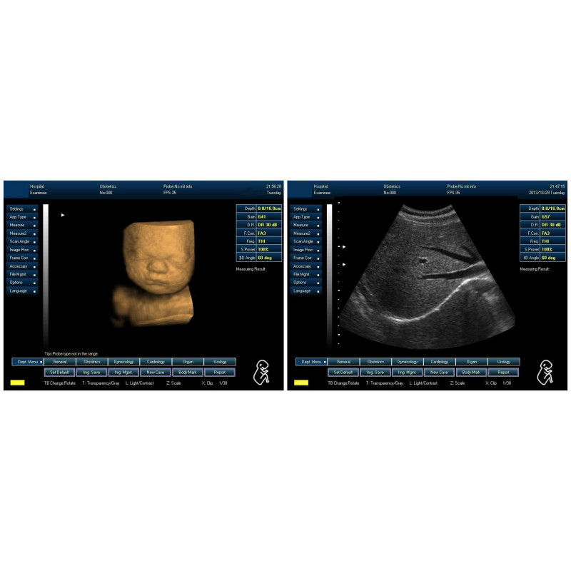 portable abdominal ultrasound clinical high quality machine cheap 3d ultrasound