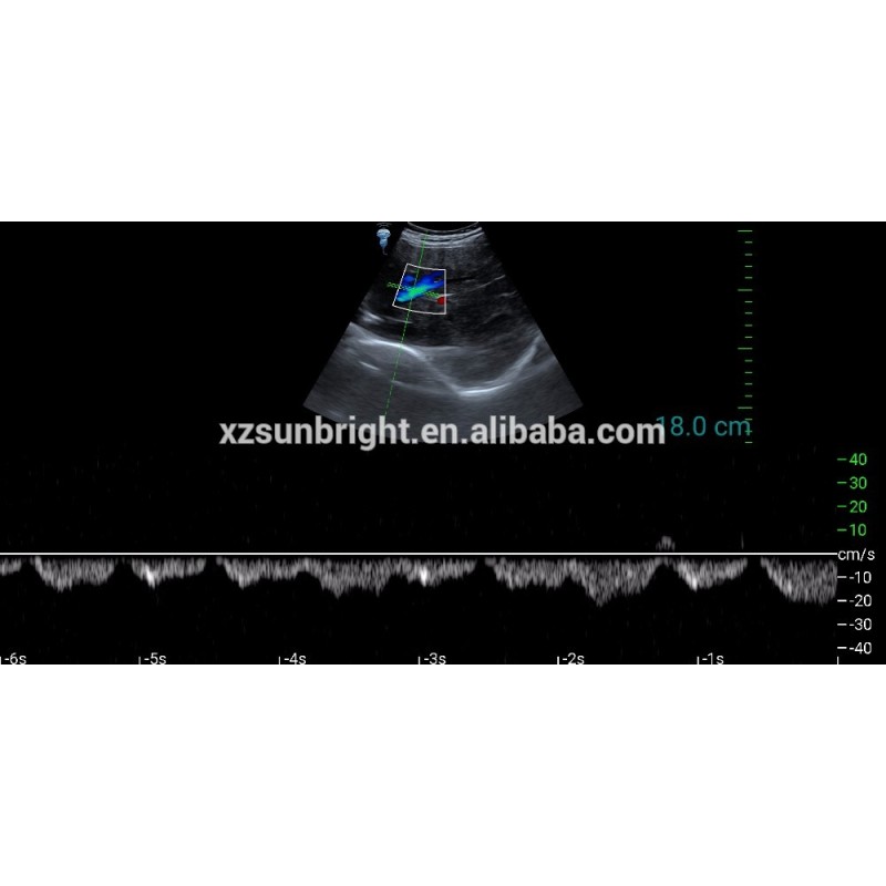 SUN-D1 prueba de embarazo color Doppler PW sonda convexa USB
